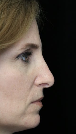 Beverly Hills Rhinoplasty Before & After Gallery - Patient 489862 - Image 2 Dr. Deepak Raj Dugar