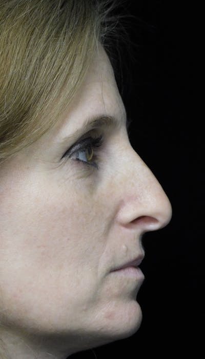 Beverly Hills Rhinoplasty Before & After Gallery - Patient 489862 - Image 1 Dr. Deepak Raj Dugar