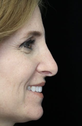 Beverly Hills Rhinoplasty Before & After Gallery - Patient 489862 - Image 12 Dr. Deepak Raj Dugar