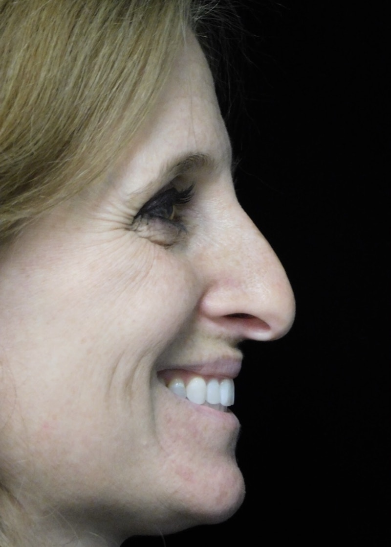 Beverly Hills Rhinoplasty Before & After Gallery - Patient 489862 - Image 11 Dr. Deepak Raj Dugar