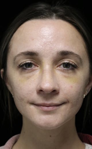 Beverly Hills Rhinoplasty Before & After Gallery - Patient 793841 - Image 4 Dr. Deepak Raj Dugar