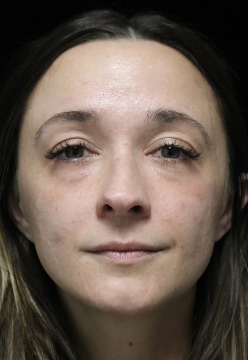 Beverly Hills Rhinoplasty Before & After Gallery - Patient 793841 - Image 3 Dr. Deepak Raj Dugar