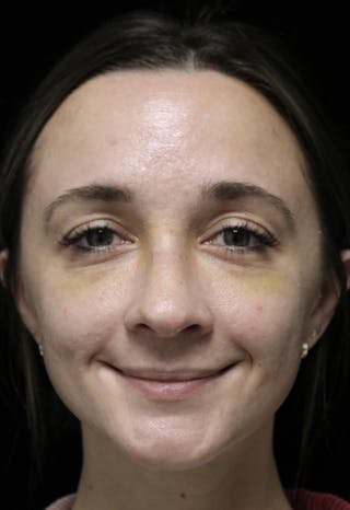 Beverly Hills Rhinoplasty Before & After Gallery - Patient 793841 - Image 6 Dr. Deepak Raj Dugar