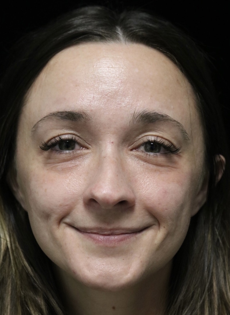 Beverly Hills Rhinoplasty Before & After Gallery - Patient 793841 - Image 5 Dr. Deepak Raj Dugar