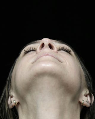 Beverly Hills Rhinoplasty Before & After Gallery - Patient 793841 - Image 8 Dr. Deepak Raj Dugar