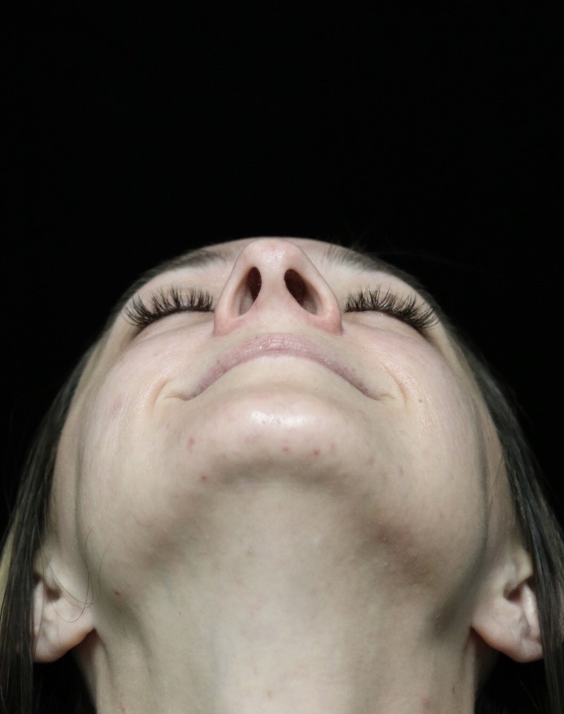 Beverly Hills Rhinoplasty Before & After Gallery - Patient 793841 - Image 7 Dr. Deepak Raj Dugar