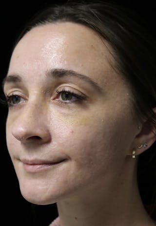 Beverly Hills Rhinoplasty Before & After Gallery - Patient 793841 - Image 10 Dr. Deepak Raj Dugar