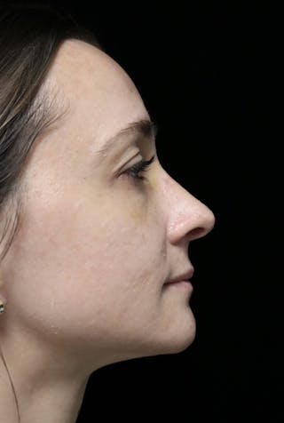 Beverly Hills Rhinoplasty Before & After Gallery - Patient 793841 - Image 2 Dr. Deepak Raj Dugar