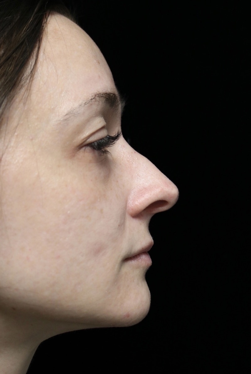 Beverly Hills Rhinoplasty Before & After Gallery - Patient 793841 - Image 1 Dr. Deepak Raj Dugar