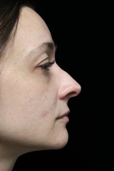 Beverly Hills Rhinoplasty Before & After Gallery - Patient 793841 - Image 1 Dr. Deepak Raj Dugar