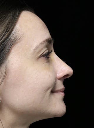 Beverly Hills Rhinoplasty Before & After Gallery - Patient 793841 - Image 12 Dr. Deepak Raj Dugar