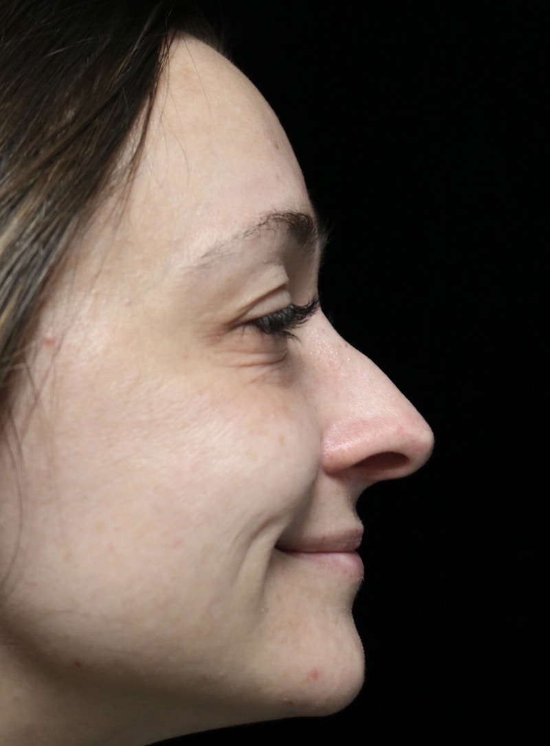 Beverly Hills Rhinoplasty Before & After Gallery - Patient 793841 - Image 11 Dr. Deepak Raj Dugar