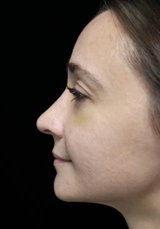 Beverly Hills Rhinoplasty Before & After Gallery - Patient 793841 - Image 14 Dr. Deepak Raj Dugar