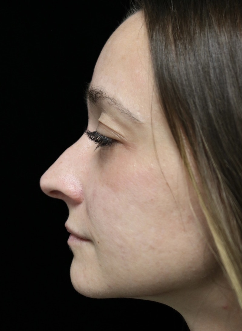 Beverly Hills Rhinoplasty Before & After Gallery - Patient 793841 - Image 13 Dr. Deepak Raj Dugar
