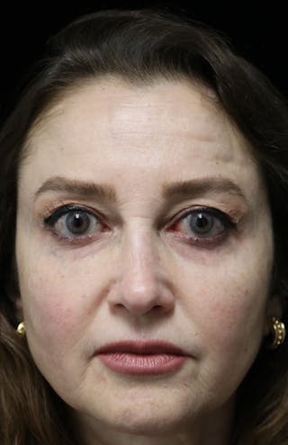 Beverly Hills Rhinoplasty Before & After Gallery - Patient 256502 - Image 4 Dr. Deepak Raj Dugar