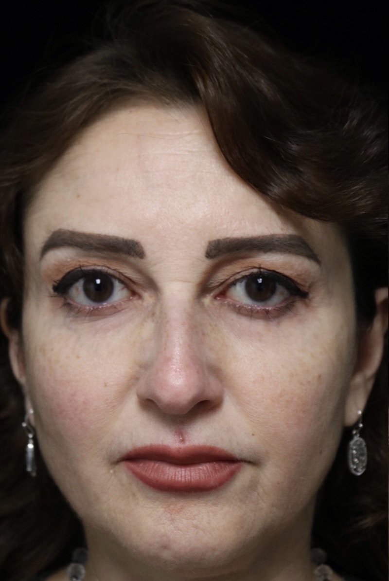 Beverly Hills Rhinoplasty Before & After Gallery - Patient 256502 - Image 3 Dr. Deepak Raj Dugar