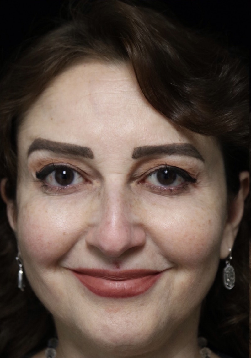 Beverly Hills Rhinoplasty Before & After Gallery - Patient 256502 - Image 5 Dr. Deepak Raj Dugar