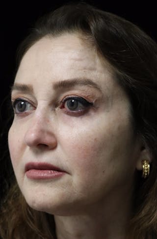 Beverly Hills Rhinoplasty Before & After Gallery - Patient 256502 - Image 10 Dr. Deepak Raj Dugar