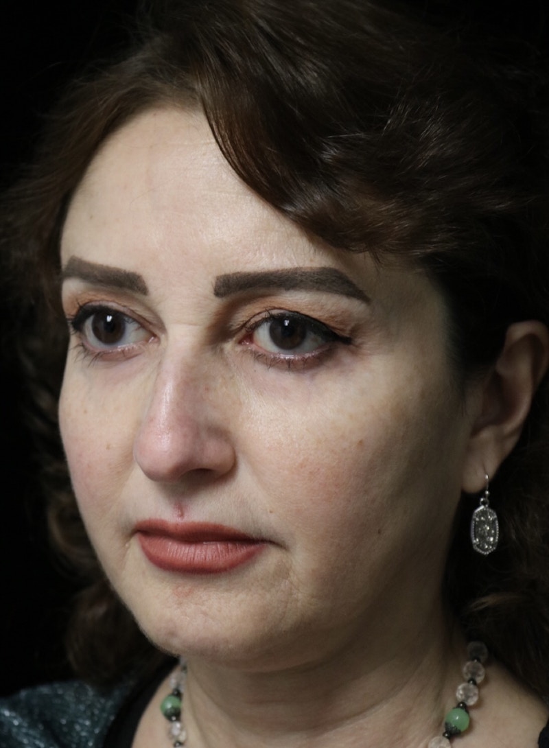 Beverly Hills Rhinoplasty Before & After Gallery - Patient 256502 - Image 9 Dr. Deepak Raj Dugar
