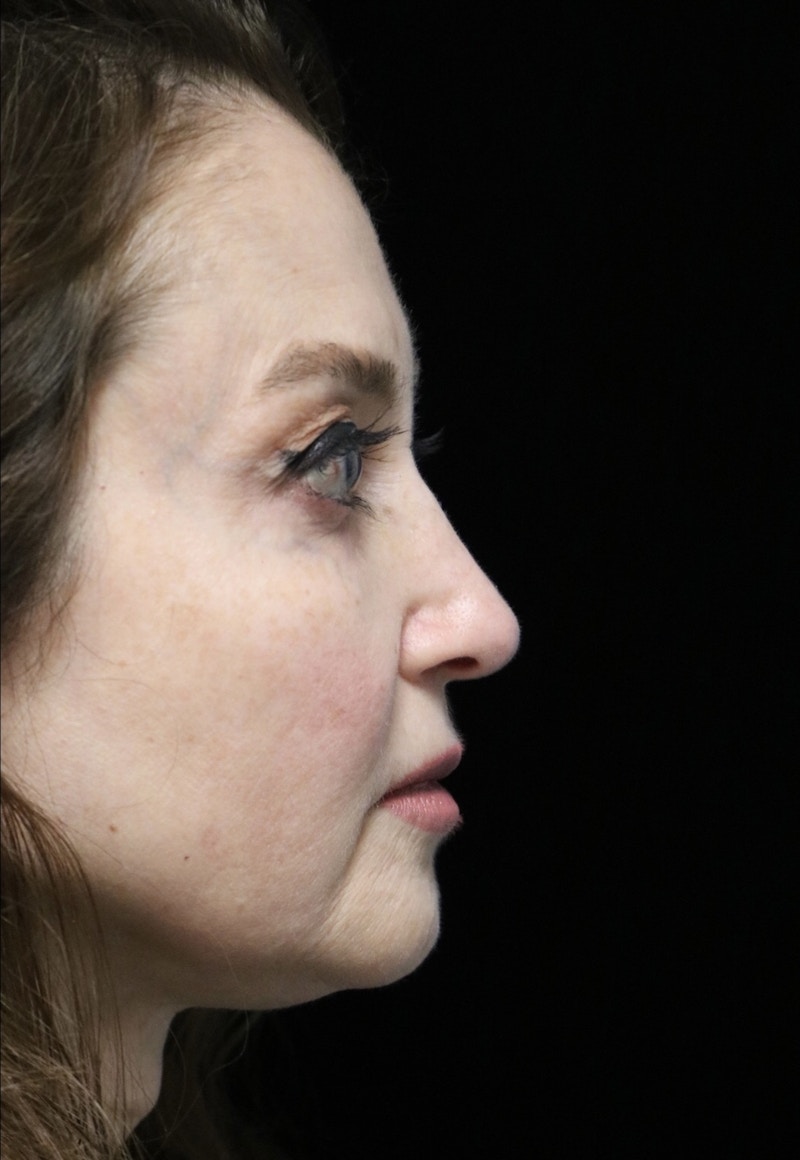 Beverly Hills Rhinoplasty Before & After Gallery - Patient 256502 - Image 2 Dr. Deepak Raj Dugar