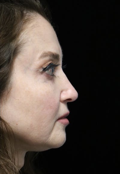 Beverly Hills Rhinoplasty Before & After Gallery - Patient 256502 - Image 2 Dr. Deepak Raj Dugar