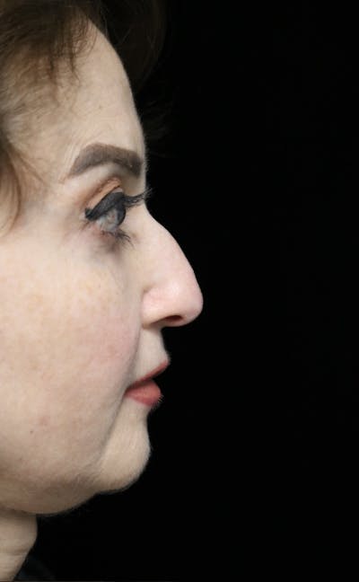 Beverly Hills Rhinoplasty Before & After Gallery - Patient 256502 - Image 1 Dr. Deepak Raj Dugar
