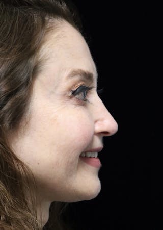 Beverly Hills Rhinoplasty Before & After Gallery - Patient 256502 - Image 12 Dr. Deepak Raj Dugar