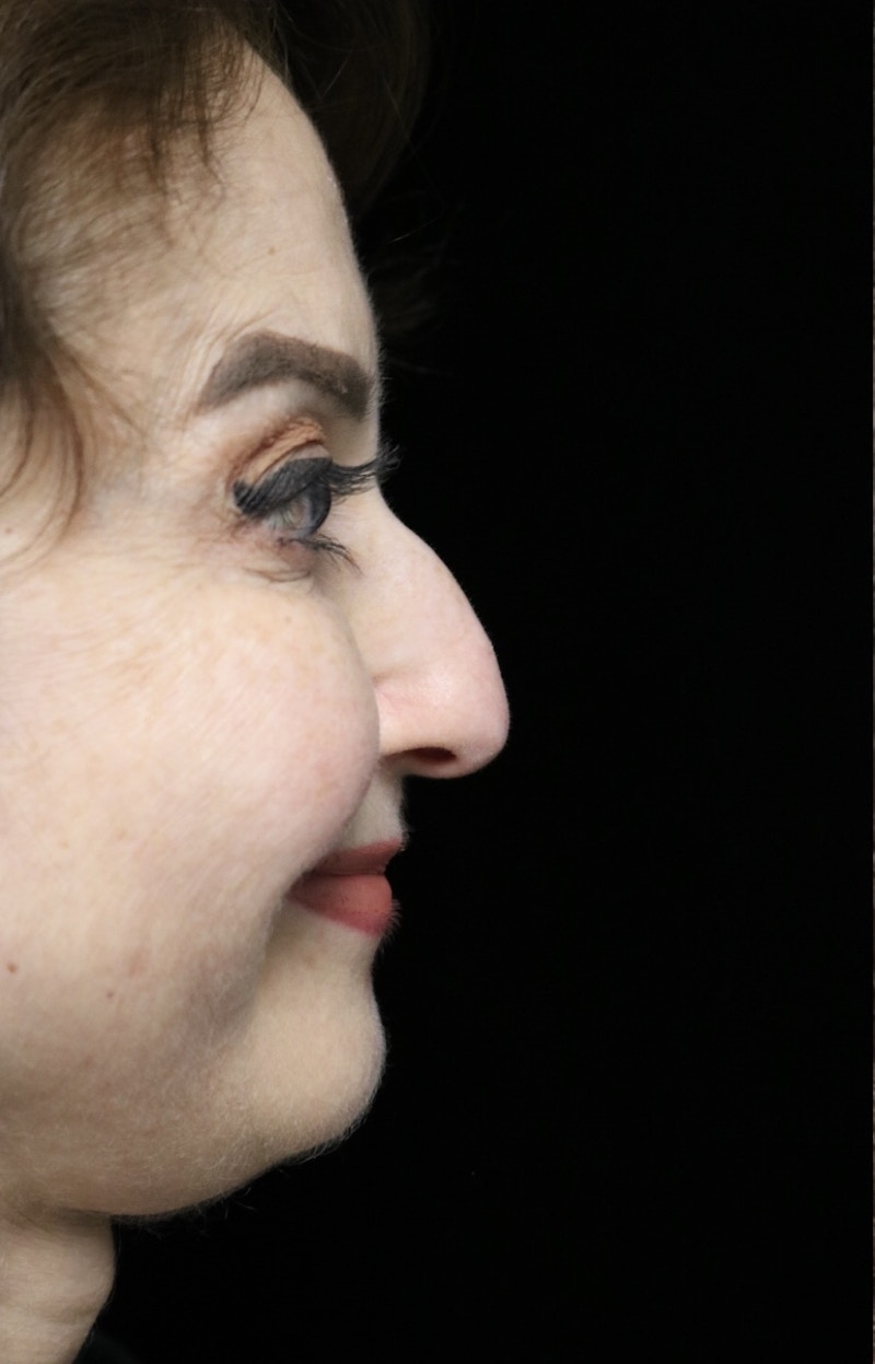 Beverly Hills Rhinoplasty Before & After Gallery - Patient 256502 - Image 11 Dr. Deepak Raj Dugar