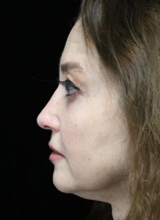 Beverly Hills Rhinoplasty Before & After Gallery - Patient 256502 - Image 14 Dr. Deepak Raj Dugar