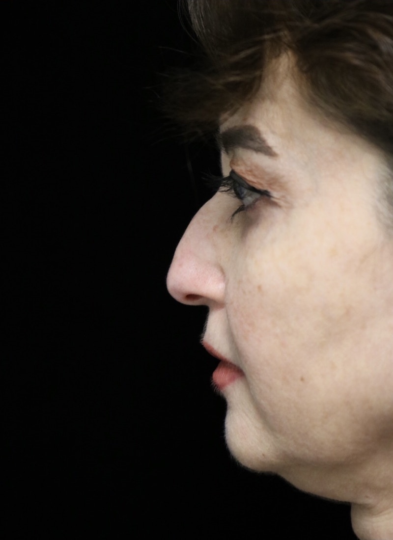 Beverly Hills Rhinoplasty Before & After Gallery - Patient 256502 - Image 13 Dr. Deepak Raj Dugar