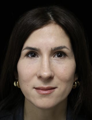 Beverly Hills Rhinoplasty Before & After Gallery - Patient 346052 - Image 4 Dr. Deepak Raj Dugar