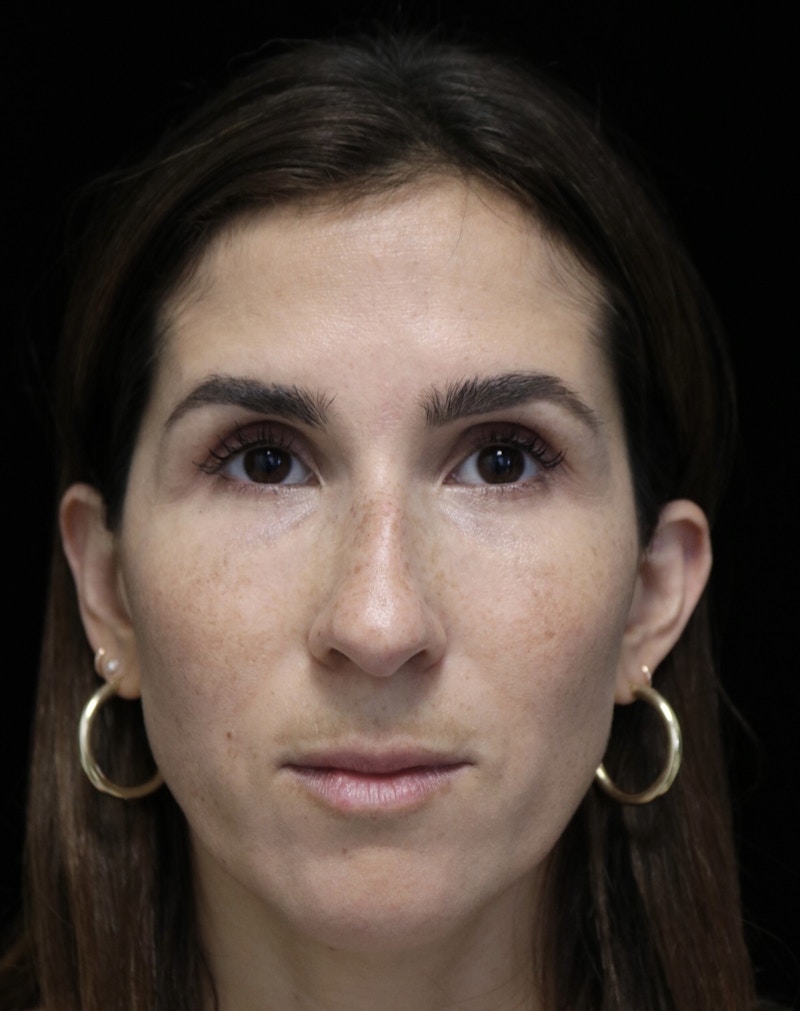 Beverly Hills Rhinoplasty Before & After Gallery - Patient 346052 - Image 3 Dr. Deepak Raj Dugar