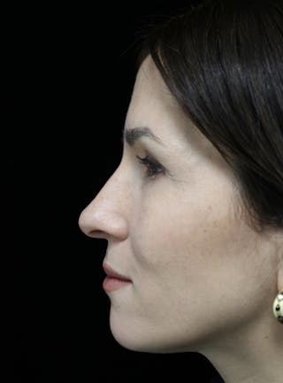 Beverly Hills Rhinoplasty Before & After Gallery - Patient 346052 - Image 6 Dr. Deepak Raj Dugar