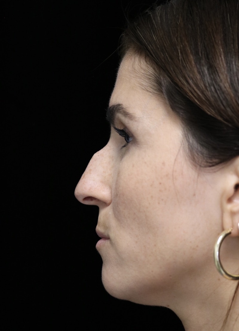 Beverly Hills Rhinoplasty Before & After Gallery - Patient 346052 - Image 5 Dr. Deepak Raj Dugar