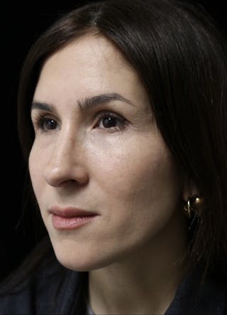 Beverly Hills Rhinoplasty Before & After Gallery - Patient 346052 - Image 10 Dr. Deepak Raj Dugar