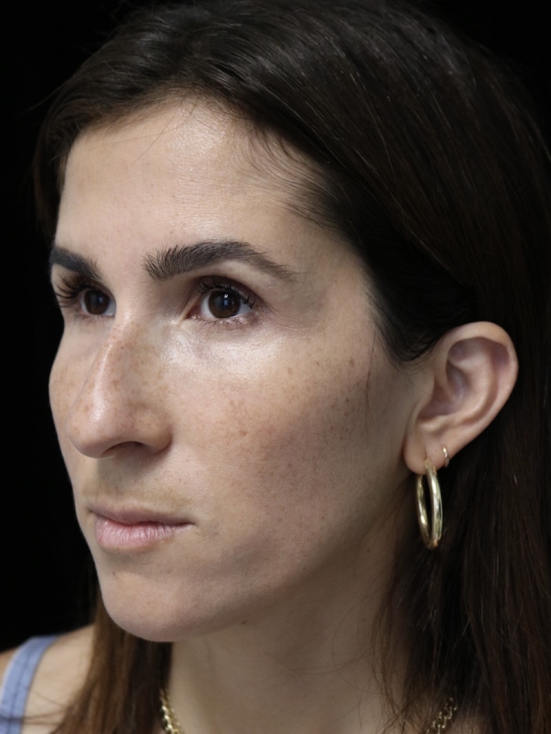 Beverly Hills Rhinoplasty Before & After Gallery - Patient 346052 - Image 9 Dr. Deepak Raj Dugar