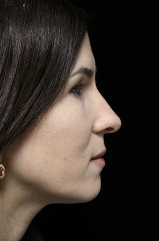 Beverly Hills Rhinoplasty Before & After Gallery - Patient 346052 - Image 2 Dr. Deepak Raj Dugar