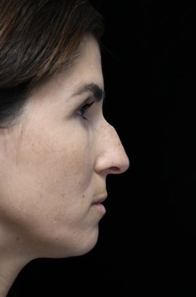 Beverly Hills Rhinoplasty Before & After Gallery - Patient 346052 - Image 1 Dr. Deepak Raj Dugar