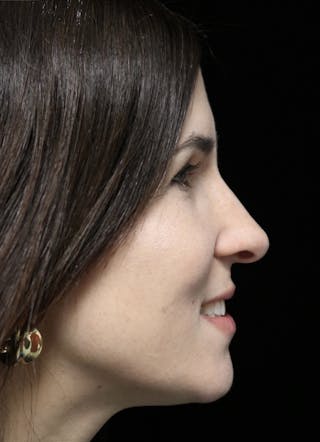Beverly Hills Rhinoplasty Before & After Gallery - Patient 346052 - Image 12 Dr. Deepak Raj Dugar