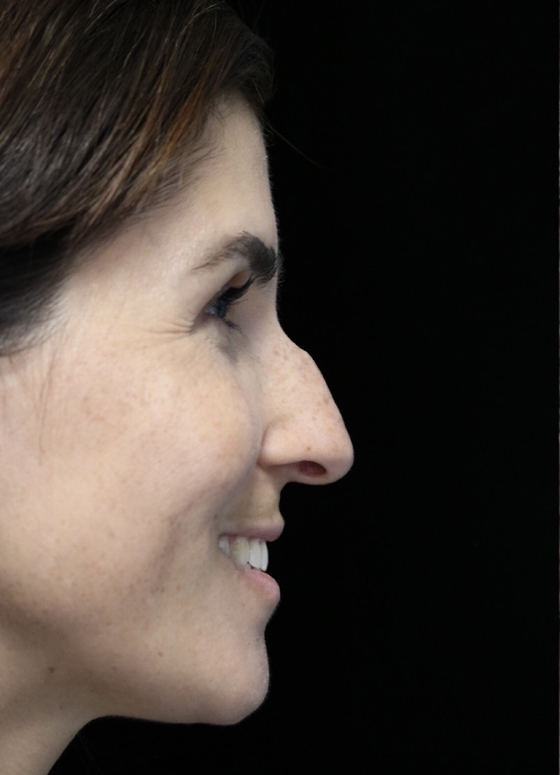 Beverly Hills Rhinoplasty Before & After Gallery - Patient 346052 - Image 11 Dr. Deepak Raj Dugar