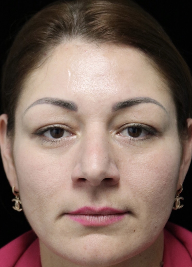 Beverly Hills Rhinoplasty Before & After Gallery - Patient 133484 - Image 3 Dr. Deepak Raj Dugar