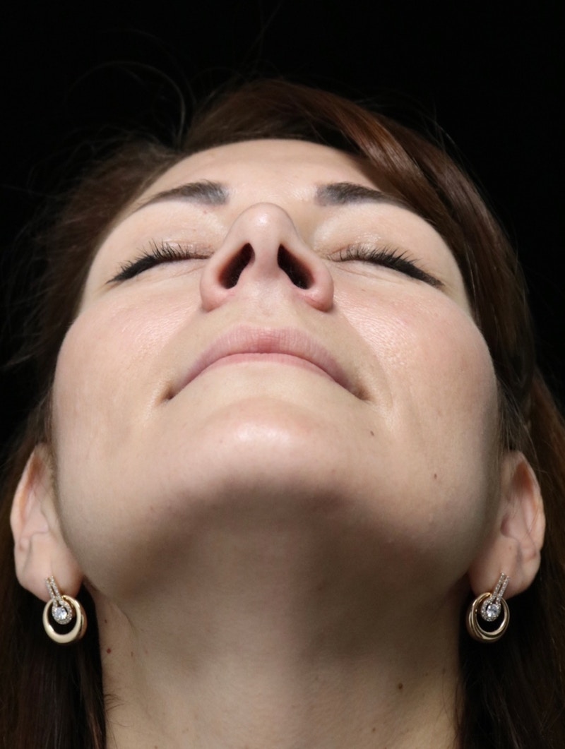 Beverly Hills Rhinoplasty Before & After Gallery - Patient 133484 - Image 8 Dr. Deepak Raj Dugar