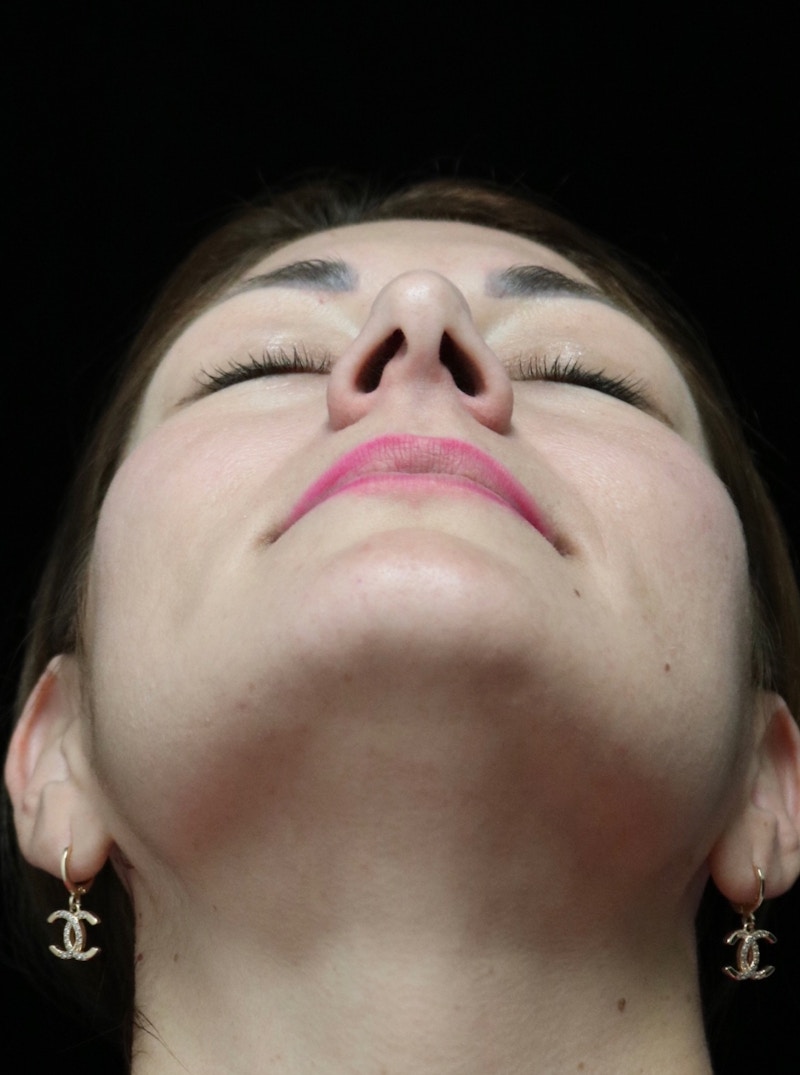 Beverly Hills Rhinoplasty Before & After Gallery - Patient 133484 - Image 7 Dr. Deepak Raj Dugar