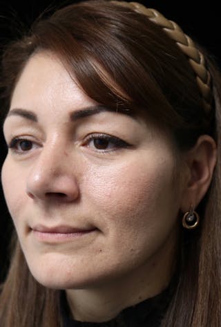 Beverly Hills Rhinoplasty Before & After Gallery - Patient 133484 - Image 10 Dr. Deepak Raj Dugar