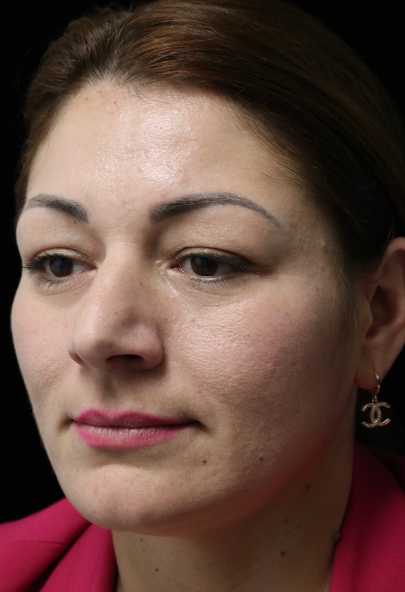 Beverly Hills Rhinoplasty Before & After Gallery - Patient 133484 - Image 9 Dr. Deepak Raj Dugar