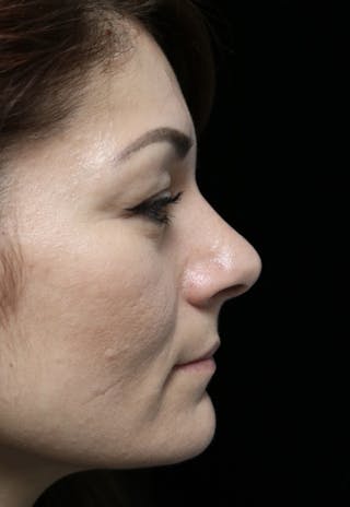 Beverly Hills Rhinoplasty Before & After Gallery - Patient 133484 - Image 2 Dr. Deepak Raj Dugar