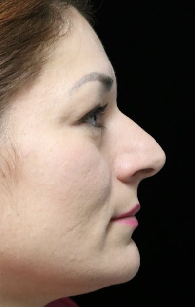 Beverly Hills Rhinoplasty Before & After Gallery - Patient 133484 - Image 1 Dr. Deepak Raj Dugar