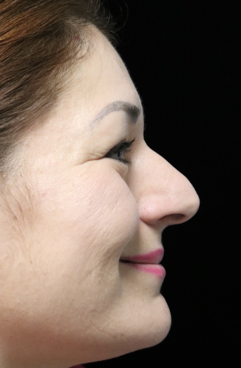 Beverly Hills Rhinoplasty Before & After Gallery - Patient 133484 - Image 11 Dr. Deepak Raj Dugar