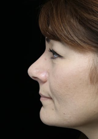 Beverly Hills Rhinoplasty Before & After Gallery - Patient 133484 - Image 14 Dr. Deepak Raj Dugar