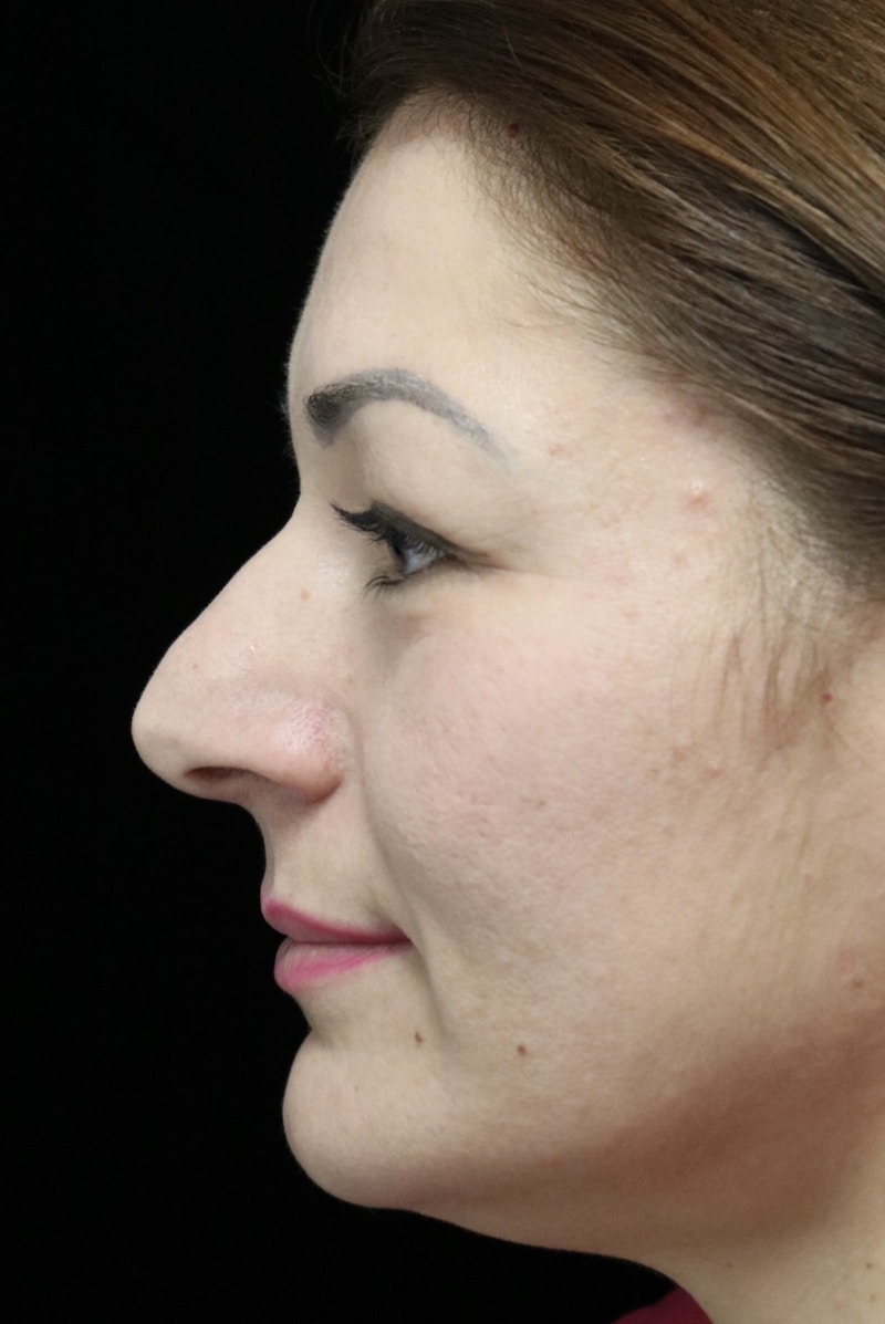Beverly Hills Rhinoplasty Before & After Gallery - Patient 133484 - Image 13 Dr. Deepak Raj Dugar